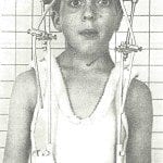 A small boy with a metal frame attached to his head